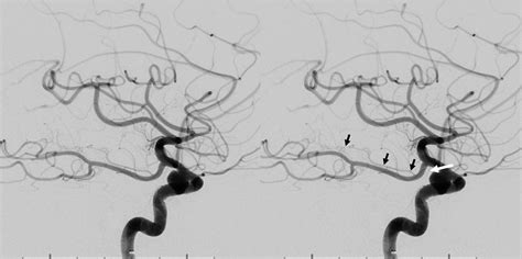 hot cross gucci anterior choroidal artery